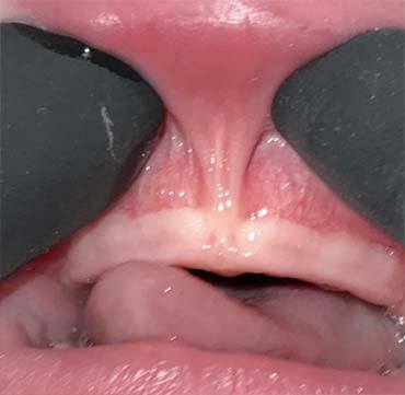 Tongue Tied Adult
