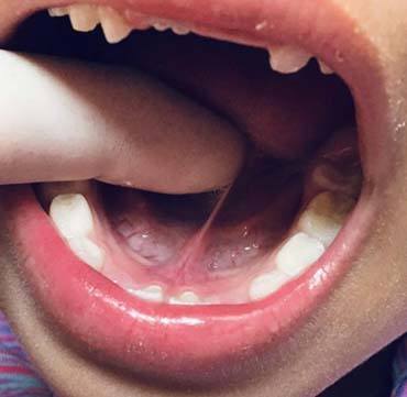 Tongue Tied Child